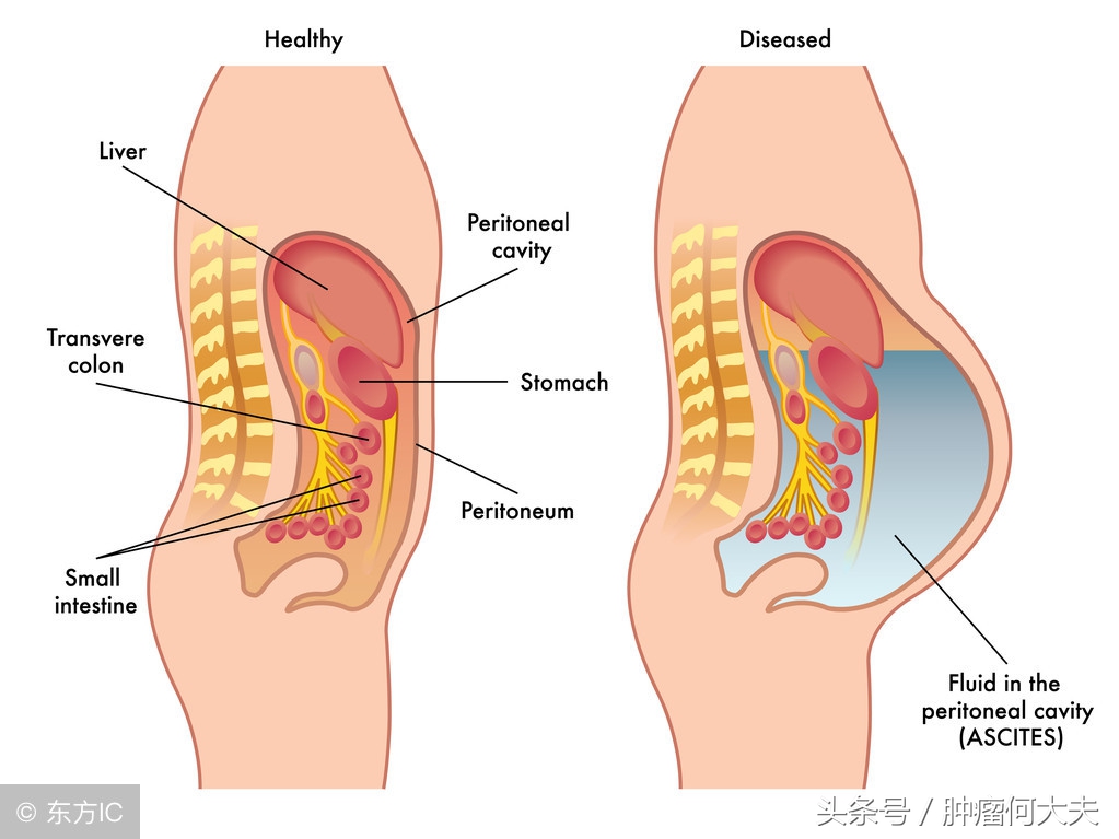 肿瘤腹腔转移有腹水能活多久,癌症晚期腹水腹腔穿刺