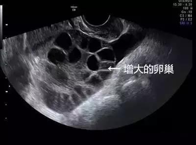 20岁女大学生捐卵,女大学生捐卵案