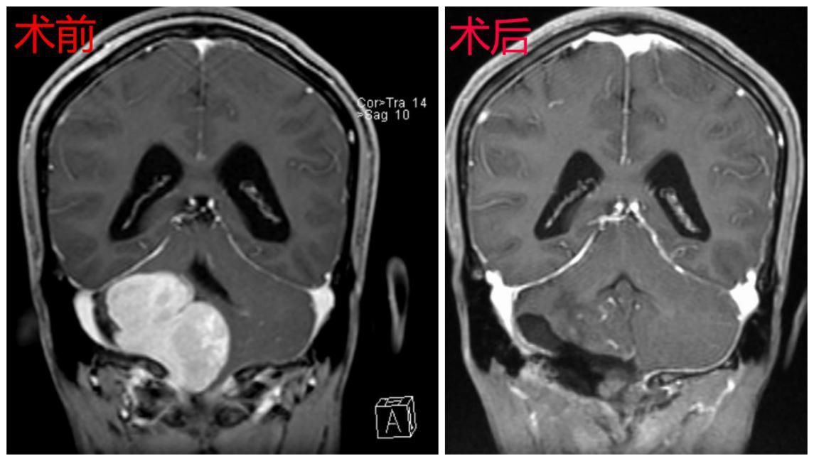 复杂脑肿瘤切除深圳二院脑科中心再创奇迹