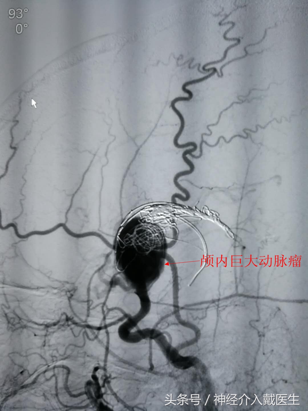 年轻人如何预防和缓解脑血管疾病,如何确诊脑血管疾病