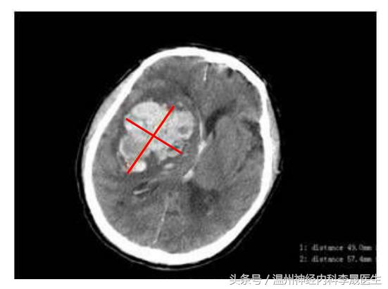 简述脑出血的内科治疗,脑出血中医解析