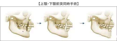 牙齿还没掉落就长出牙歪了怎么办,才补完牙很毛躁