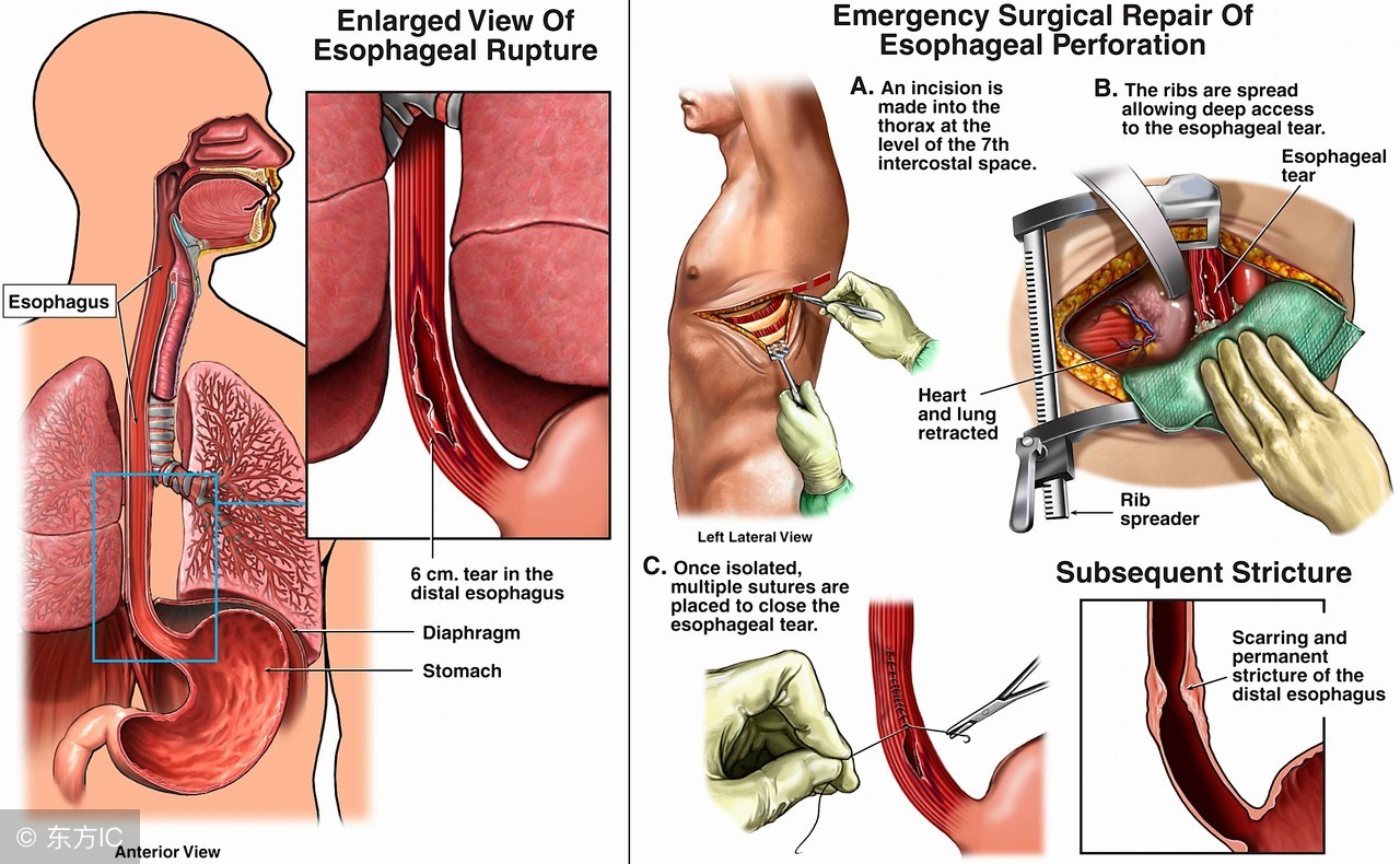 得了食管癌可以活多少年,患食管癌者一般能存活多久