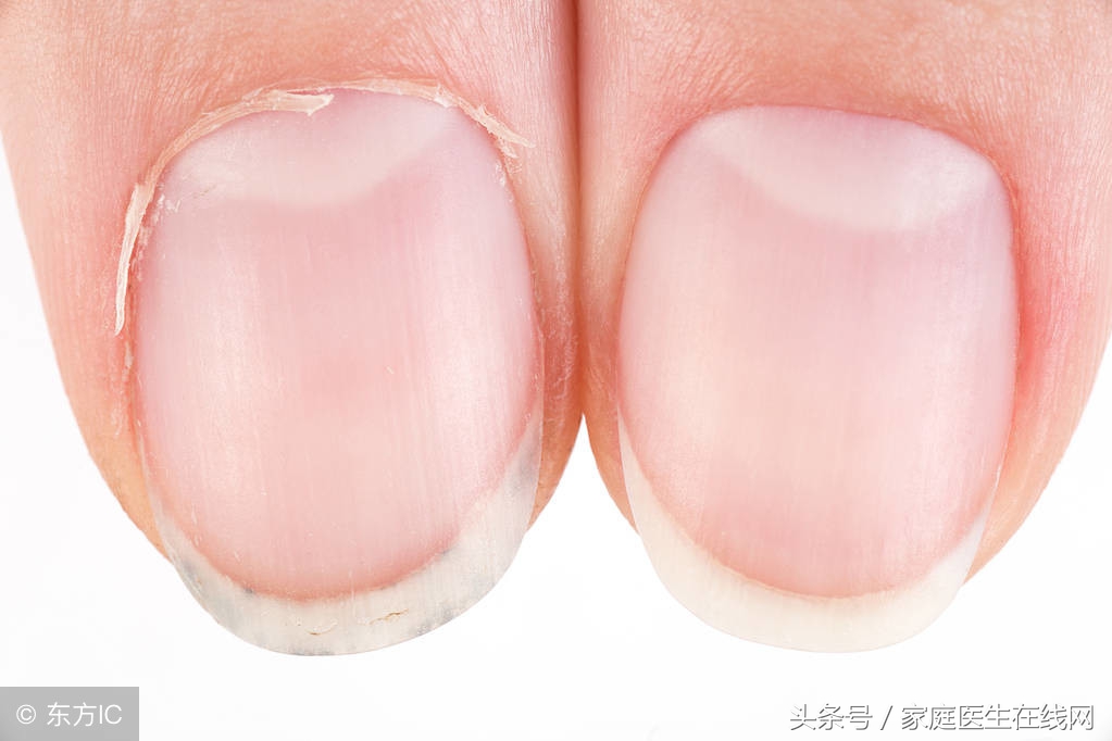 指甲盖掉了怎么处理恢复得快,指甲盖掉了用什么药才能好得快