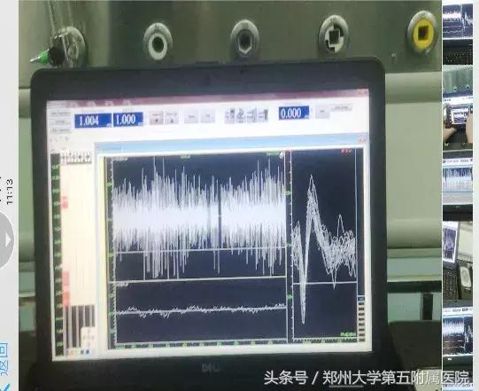 郑州大学第一附属医院治疗帕金森,郑州大学五附院脑梗康复治疗