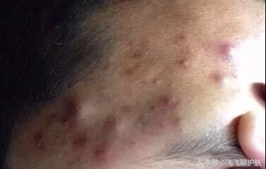 只有长痘才知道痘痘有多难治,要知道痘痘的根源