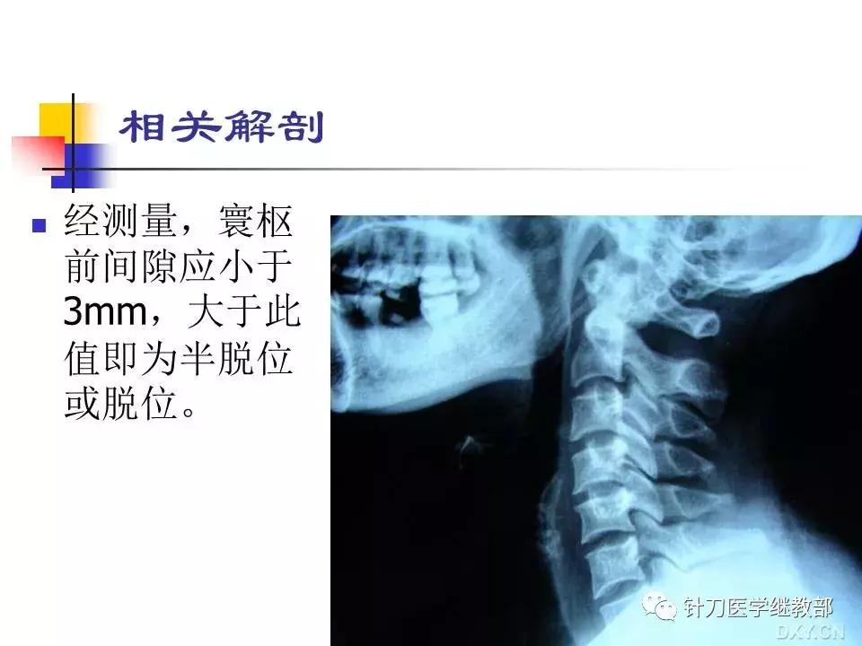 椎动脉型颈椎病错位了怎么治疗,颈椎寰枢关节错位复位手法