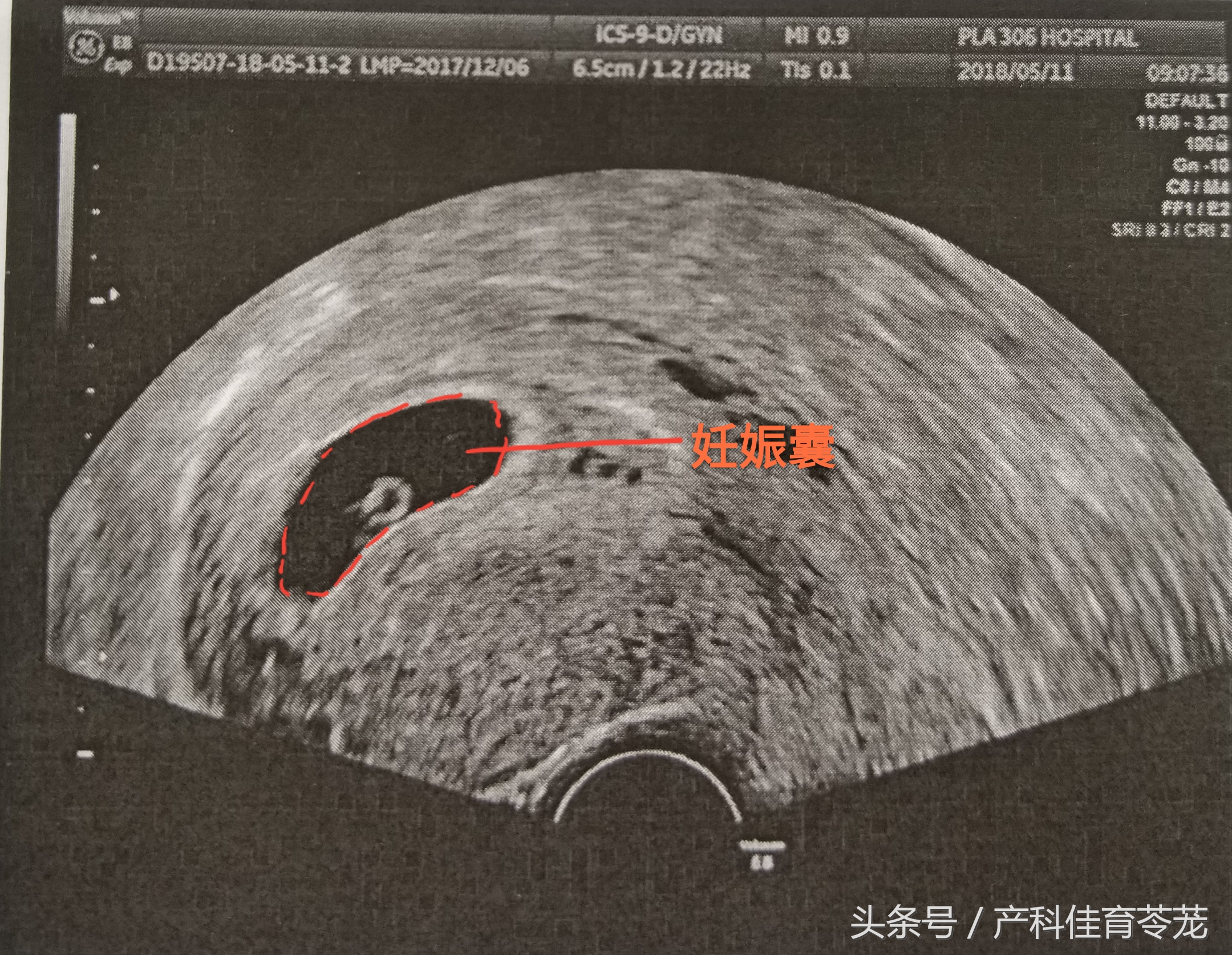 如何看懂乳腺超声检查报告,怎么能让临床医生看懂超声报告