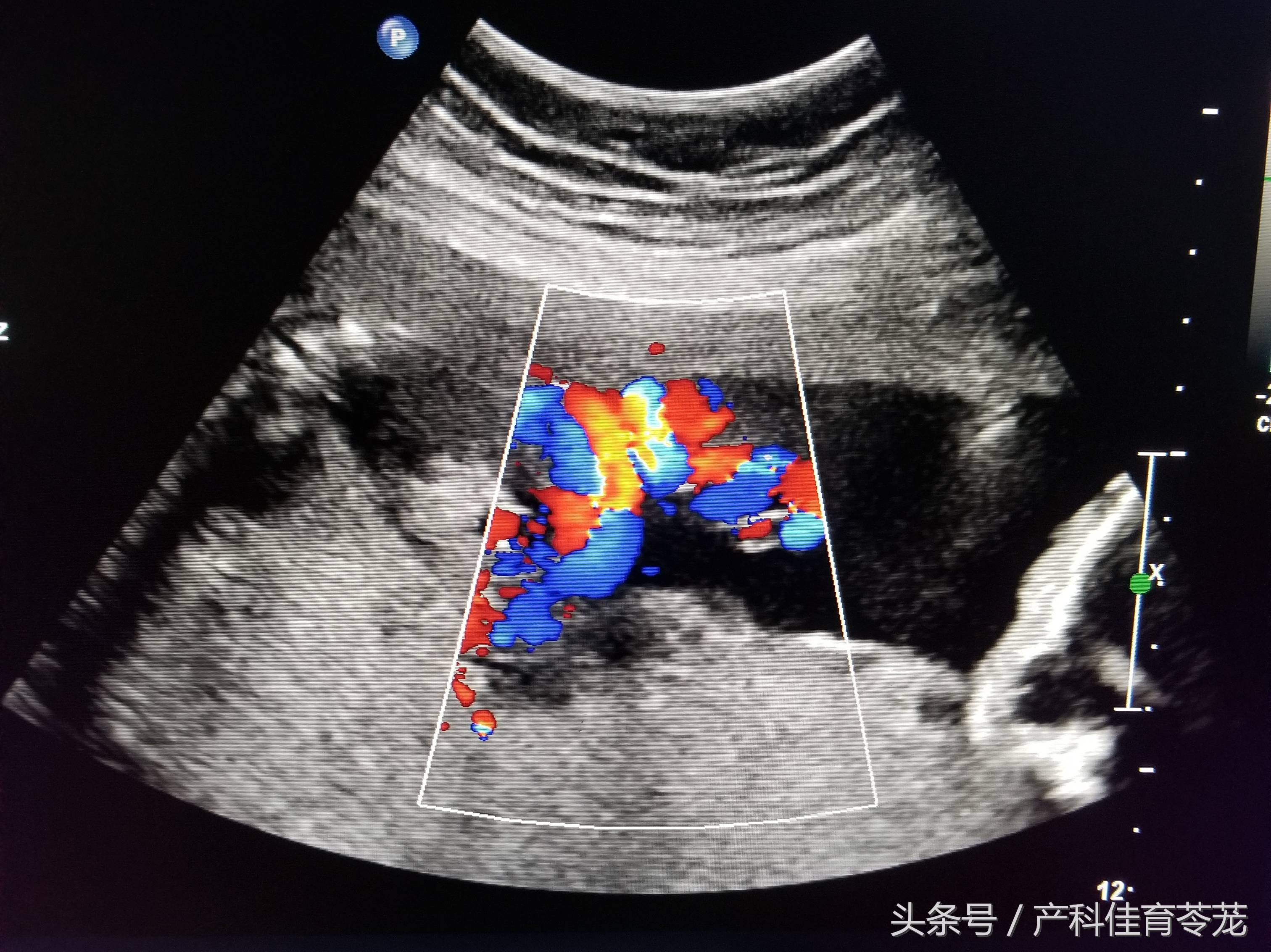 b超的3组数字代表什么,b超图片上的数字