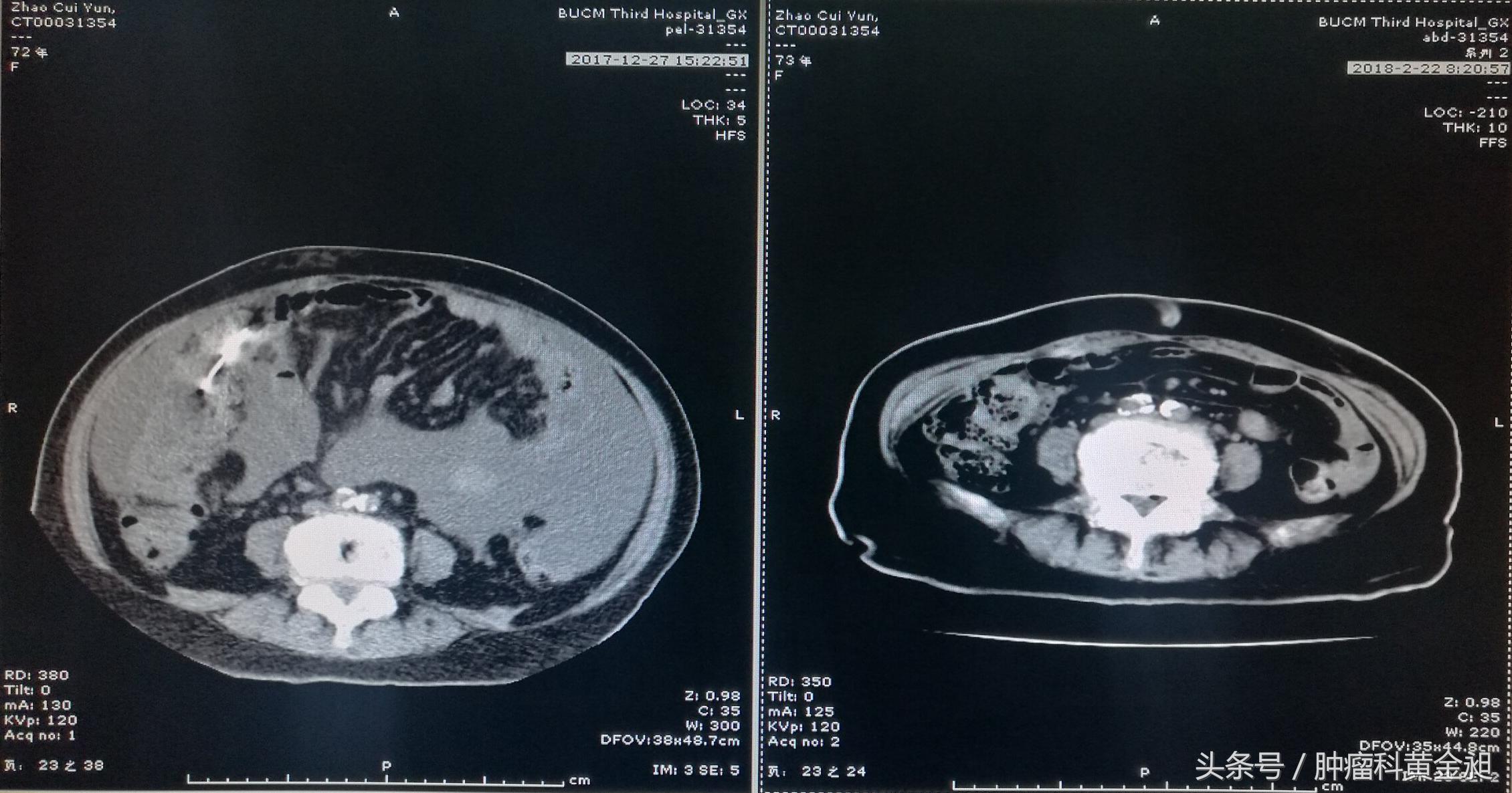 病案分享:中西医结合治疗老年卵巢癌晚期至肿瘤影像学消失1例