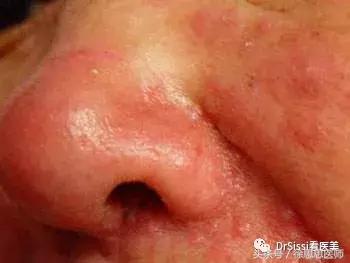 脸上80%的斑点反反复复,脸上1000多个痘坑