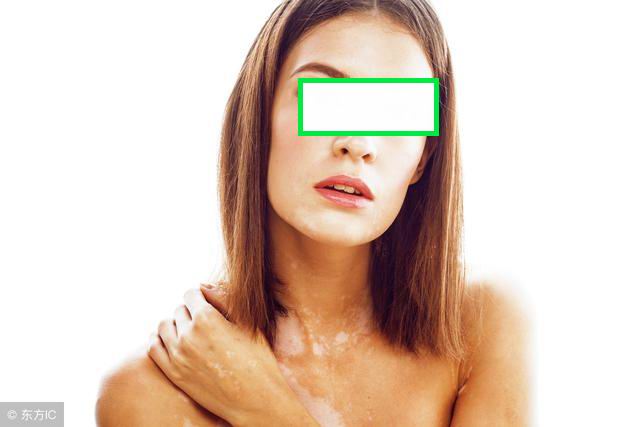 白癜风怎么治疗呢常用药有哪些,楝树花治疗白癜风