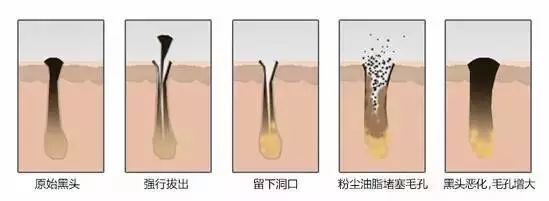 有效快速去黑头的小妙招,怎么去黑头小窍门8招简单有效