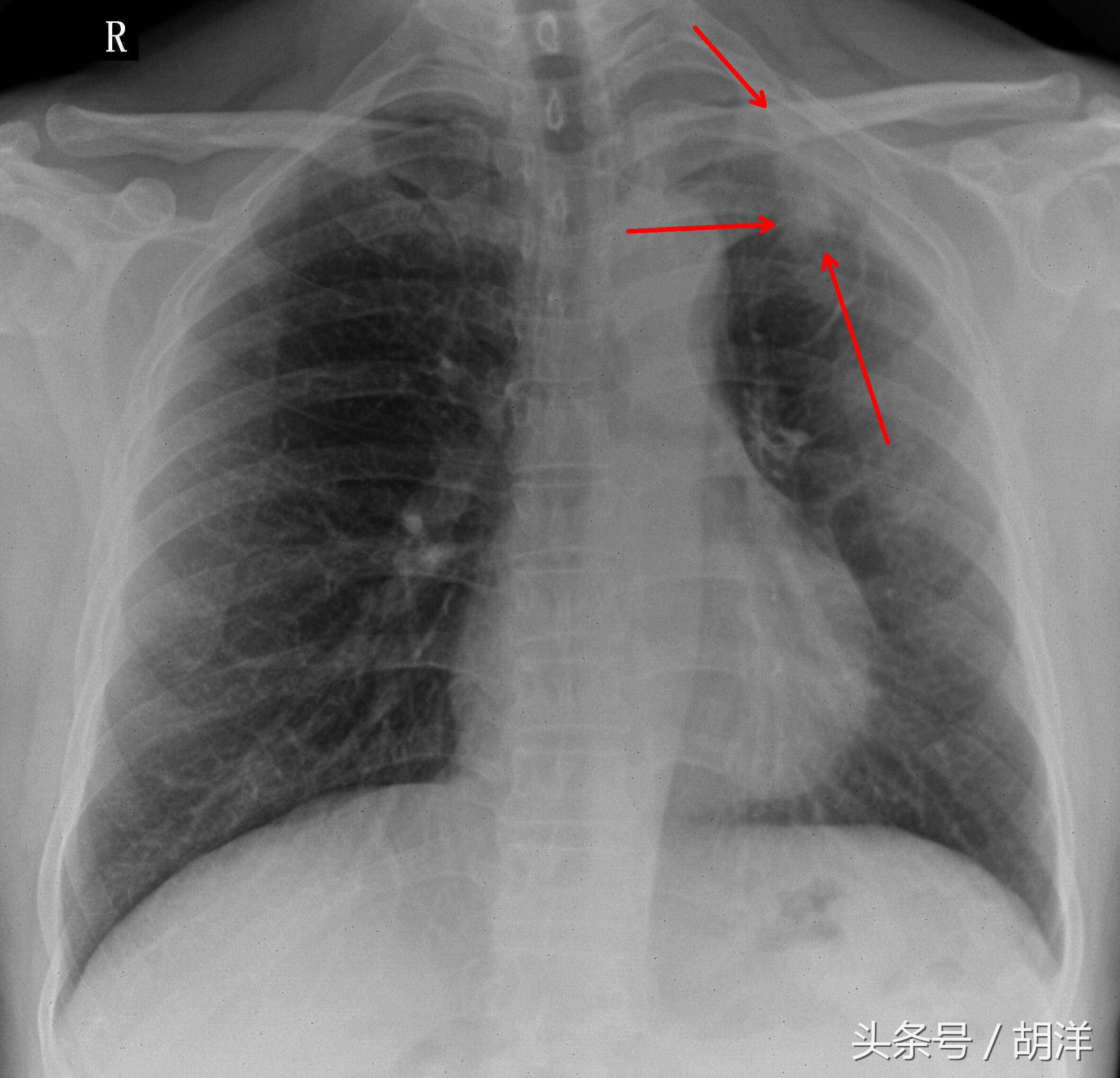 肺结核钙化会转成肺癌吗,肺结核病灶已经钙化是怎么回事