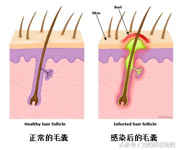 头皮毛囊炎吃哪种抗生素最有效,头皮毛囊炎口服什么抗生素最好