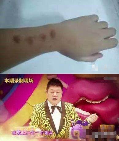 高晓松烟疤,高晓松烫烟疤