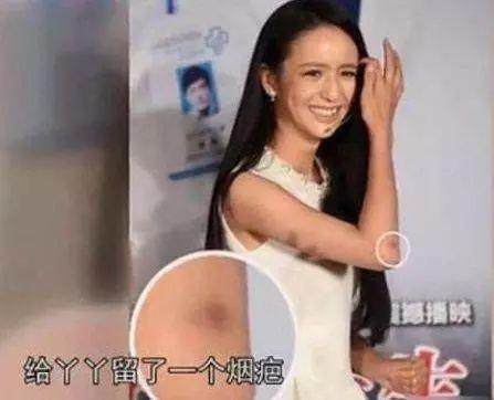 高晓松烟疤,高晓松烫烟疤