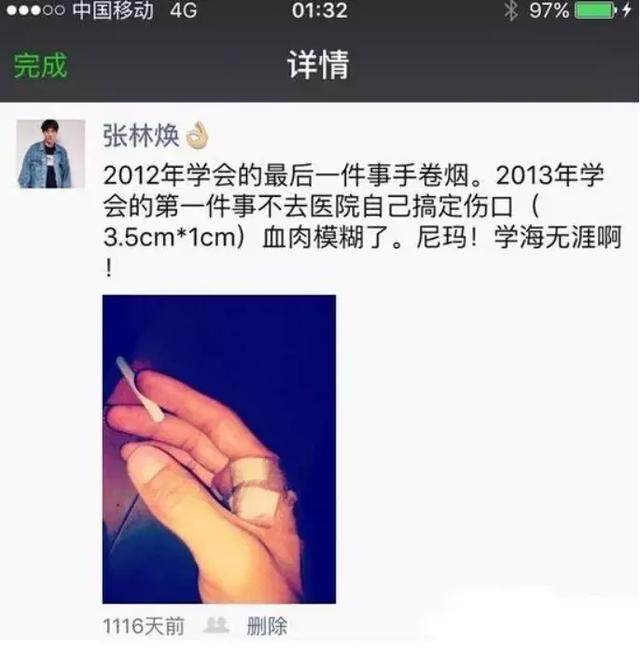 高晓松烟疤,高晓松烫烟疤