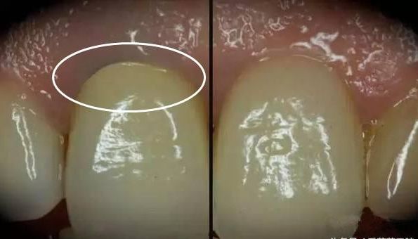 儿童牙齿上有黑色的污垢怎么去除,牙齿上有黑色的污垢用什么牙膏