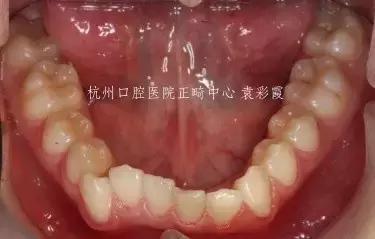 原来，上牙盖住下牙太多，也对牙齿有伤害！该怎么矫正？