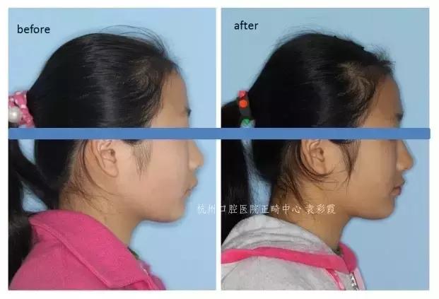 原来，上牙盖住下牙太多，也对牙齿有伤害！该怎么矫正？