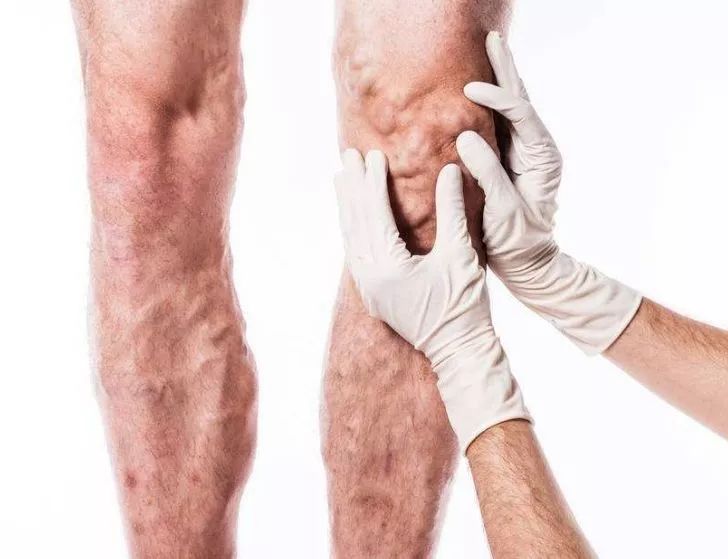 美女一条腿“暴涨”还发红发烫，只因吃了……姑娘们千万别为“大姨妈”乱吃这种药！