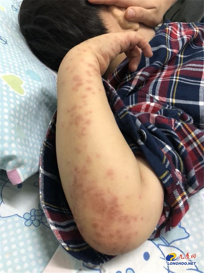 5岁孩子高烧是幼儿急疹么,5岁孩子高烧不退嘴巴长满溃疡