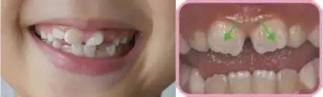 口腔科普儿童换牙常识,儿童换牙后牙缝大需要做矫正吗