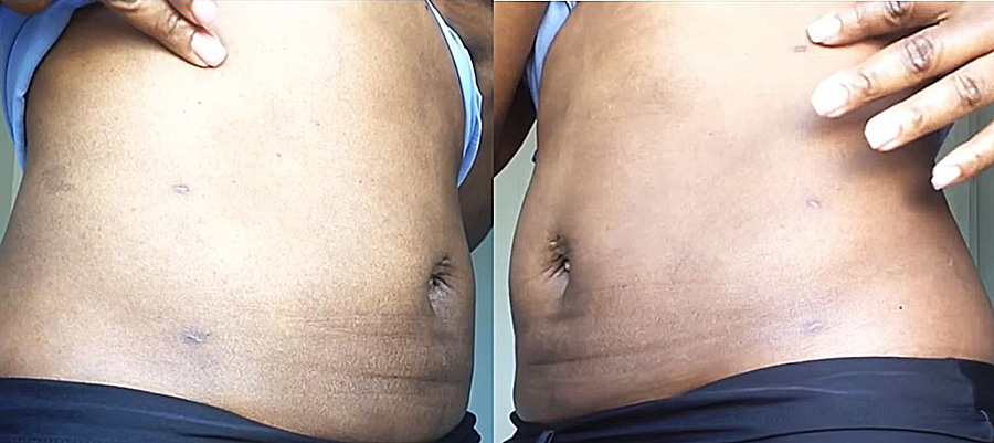 吸脂减肥前后对比图片,吸脂减肥全部过程视频术后