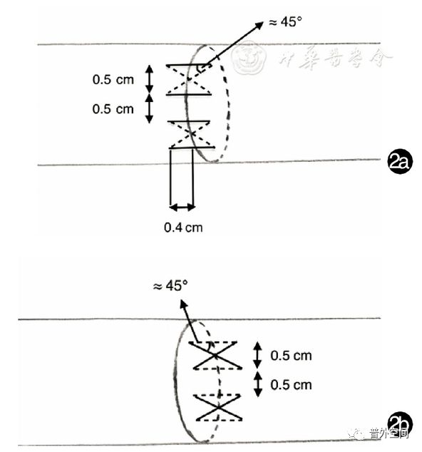 腹腔镜结直肠手术的应用指征,内8字型缝合法详细步骤