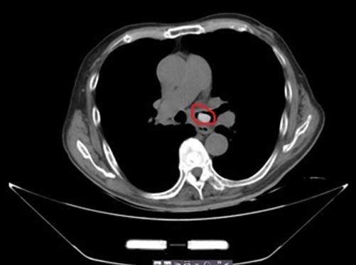 枇杷核卡入气管大爷胸闷气急险丧命医生教你一招