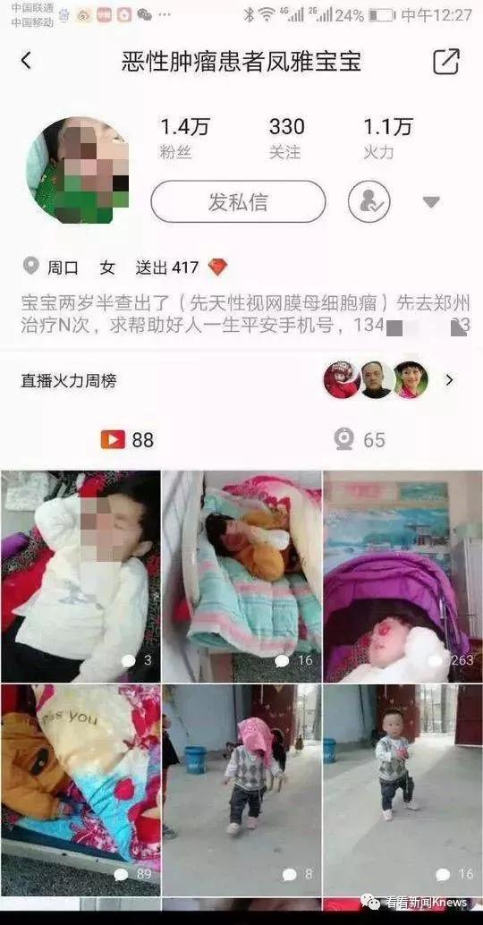 反转？！父母拿3岁患癌女儿捐款治儿子兔唇？嫣然基金：弟弟是我们给钱治的