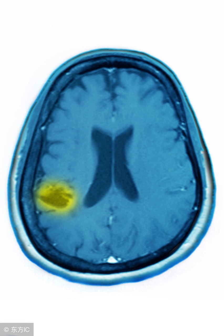 脑萎缩的护理措施,脑萎缩的正确护理方法