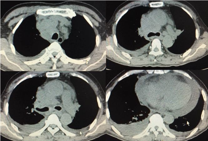 抗核治疗后反而病情加重？这个病例太经典了！