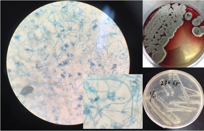 抗核治疗后反而病情加重？这个病例太经典了！