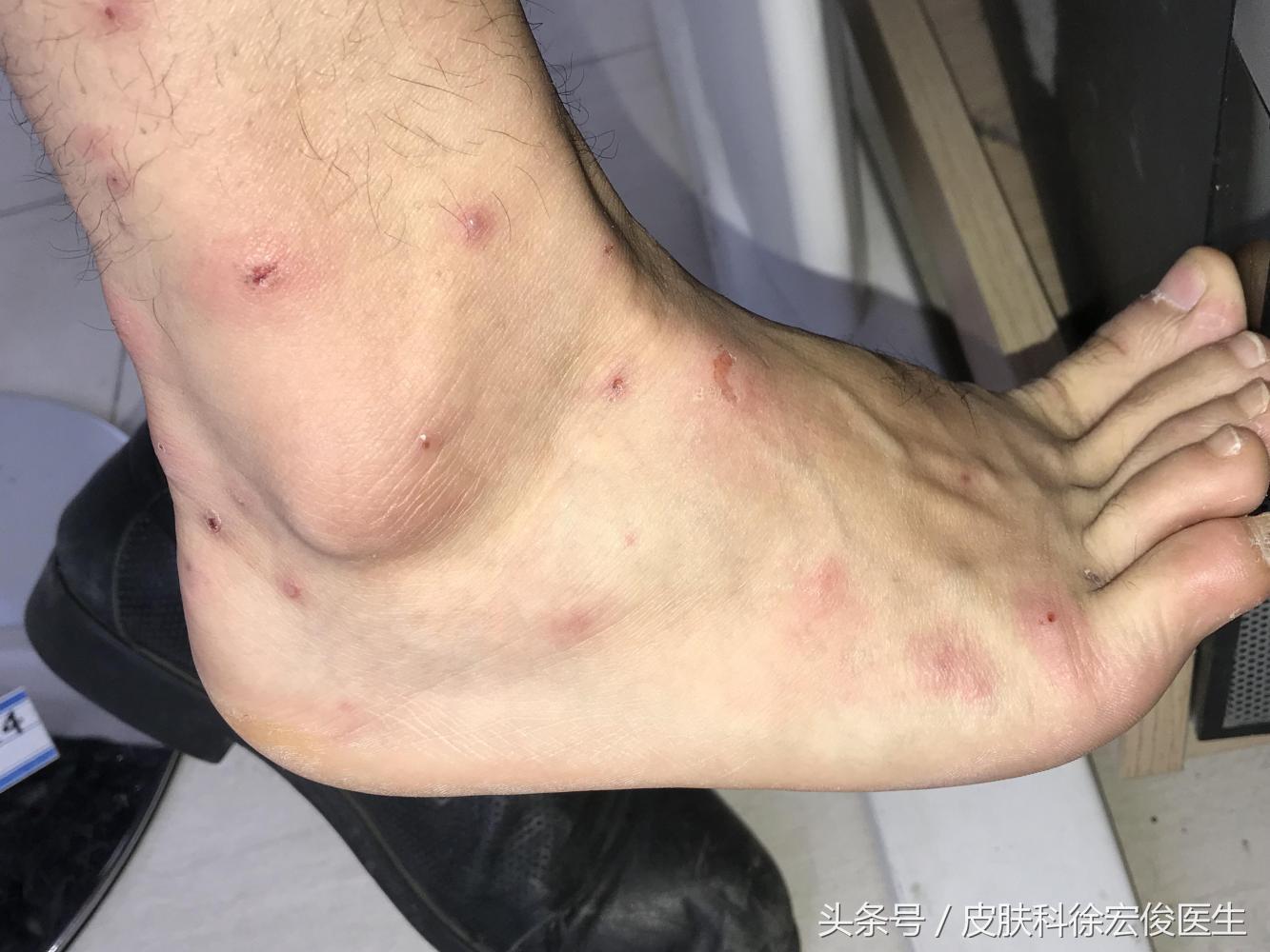 身上起红疙瘩很痒是臭虫咬的吗,臭虫咬人起疙瘩瘙痒怎么办