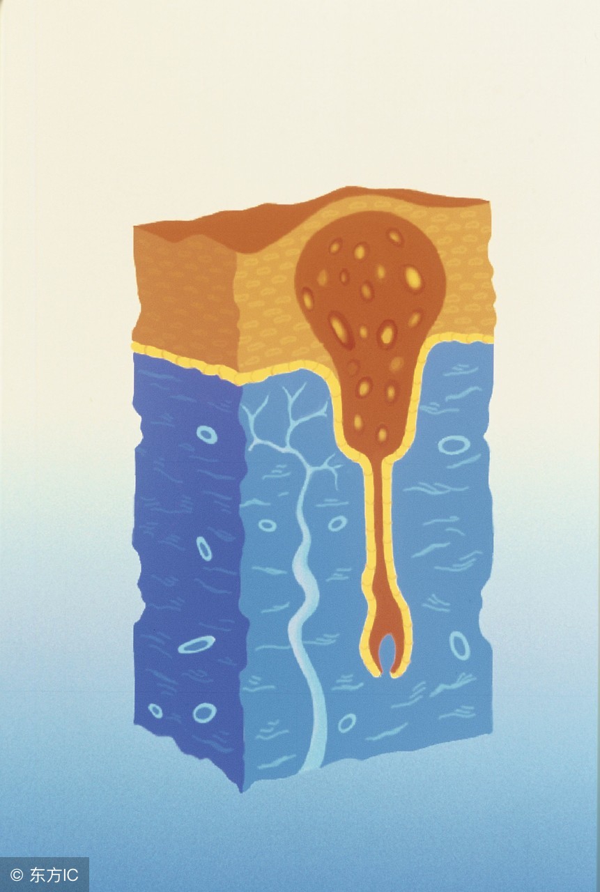 毛囊炎是怎么样引起的，发病原因有啥