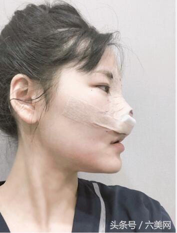 隆鼻后如何克服焦虑,隆鼻后前三天状态