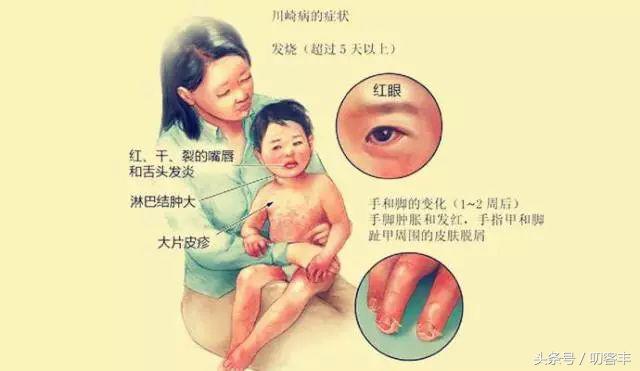 川崎病引起的儿童血管炎能自愈吗,血管炎和川崎病影像学鉴别