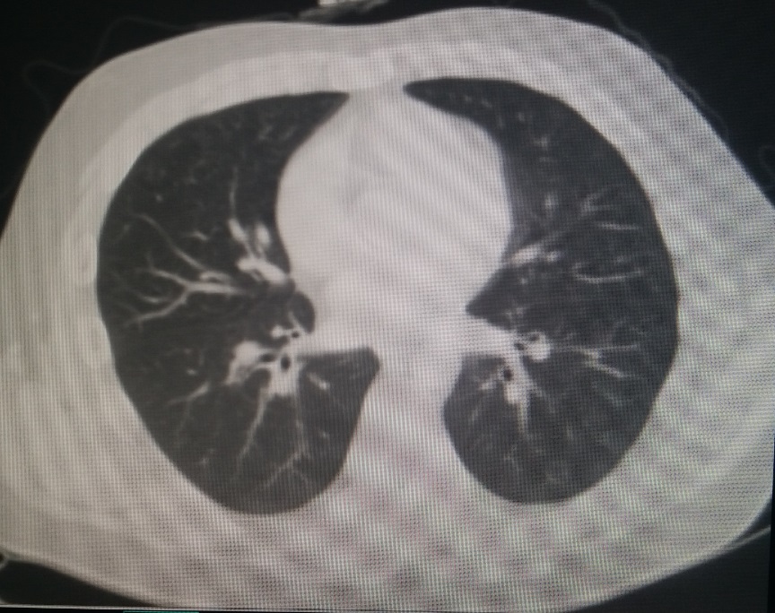 今天上午:重度桶状胸的“小手术”