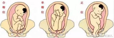 准孕妈妈要注意啥,胎位不正的准妈妈