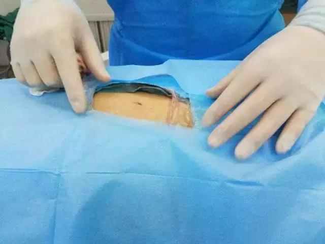 腰椎骨折怎么到医院看病,腰椎病理性骨折怎么冶