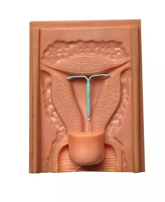 女人取出节育环后几天可以恢复,想生二胎节育环什么时候取最合适