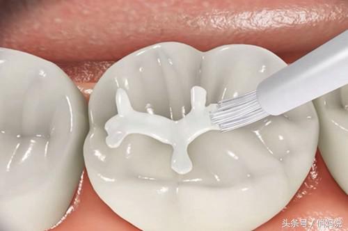 幼儿园为什么会有龋齿,小朋友为什么会有蛀牙幼儿园