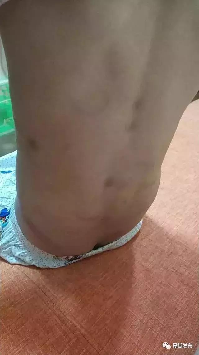 4岁男孩被打满身伤痕,小孩被父母暴打脸打肿