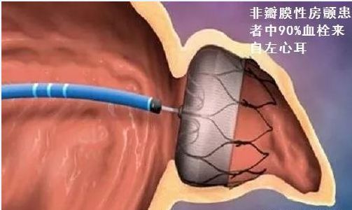 心房颤动是严重心律失常吗,心房颤动引起的心衰怎么办
