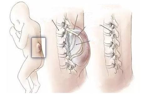 孕期补充叶酸很重要！宝宝“脊柱裂开了”怎么办？