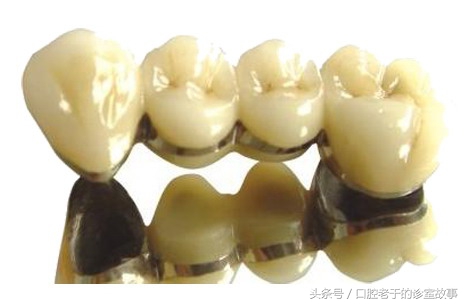 22岁缺一颗镶牙还是种植牙好,牙掉了是搭桥好还是种植牙好