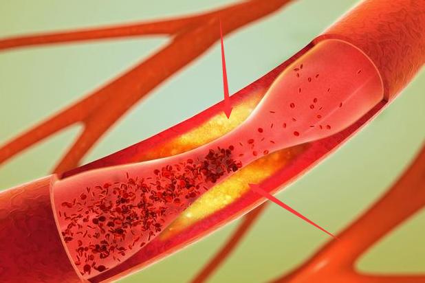 脑血栓和脑梗怎么彻底治疗,脑血栓和脑梗能治好吗