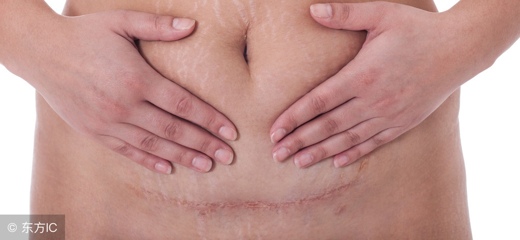 准妈妈剖腹产后别任性,不想刀口变黑,要做到以下3点